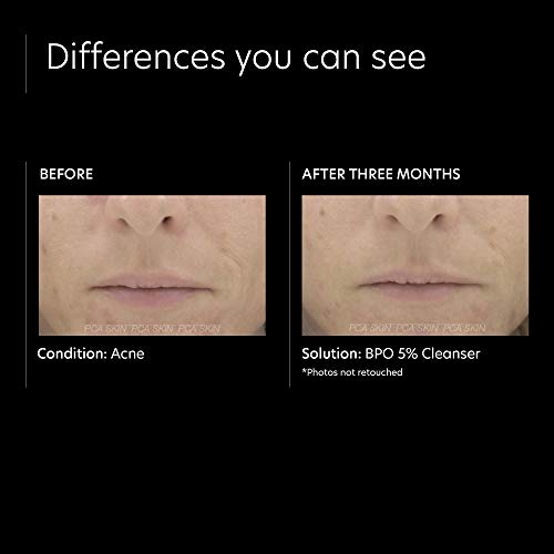 PCA SKIN Benzoyl Peroxide 5% Facial Cleanser - Foaming Daily Face Wash for Oi...