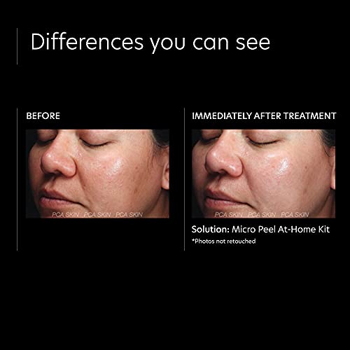 PCA SKIN Micro Peel Hyperpigmentation & Dark Spot Corrector Kit (Lactic Acid ...