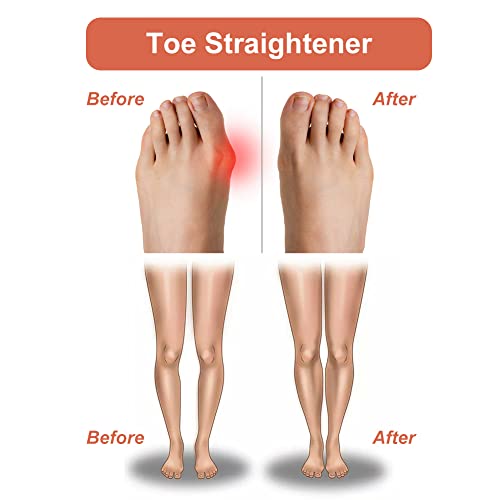 Toe Separator,Toe Spacers,Toe Straightener,Toe Spreaders to Correct Bunions a...