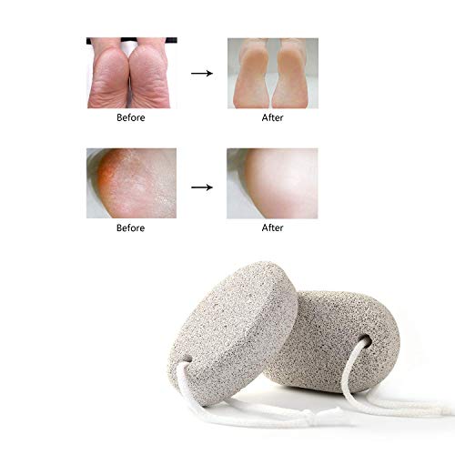 Natural Pumice Stone for Feet 2 PCS, PHOGARY Lava Pedicure Tools Hard Skin Ca...