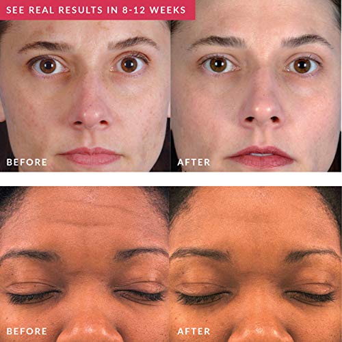 PMD Personal Microderm Classic - At-Home Microdermabrasion Machine with Kit f...