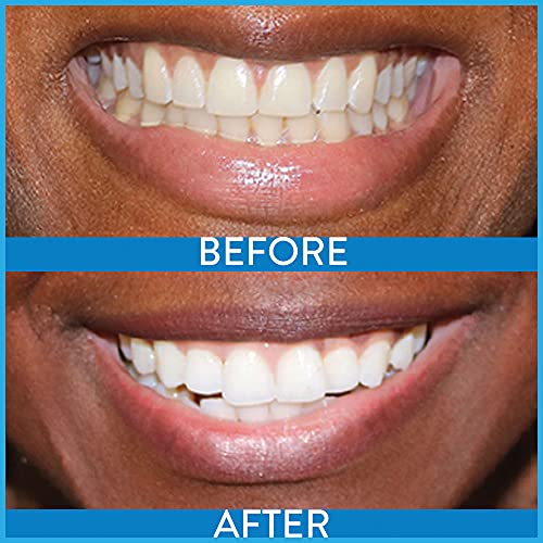 Power Swabs Teeth Whitening Kit | Easy 7 Day Treatment for Whiter Teeth | Den...