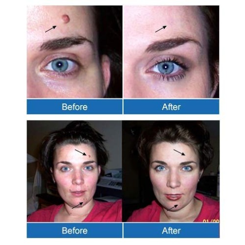 Pristine Herbal Touch - Wart & Mole Vanish, All Natural Mole & Skin Tag Remov...