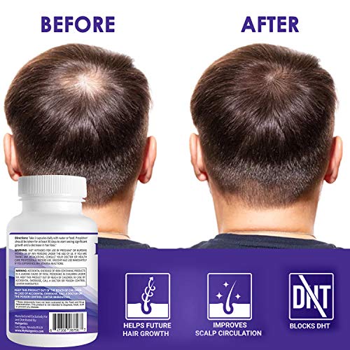 Propidren by HairGenics - DHT Blocker with Saw Palmetto To Prevent Hair Loss ...