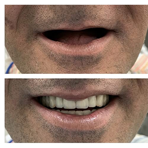 Custom Denture Full Set by Professional Dental Lab, Immediate Transitional De...