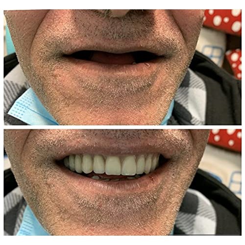 Custom Denture Full Set by Professional Dental Lab, Immediate Transitional De...