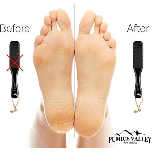 Pumice Stone Foot Scrubber - Pedicure Foot File with Handle for Dry Dead Skin...