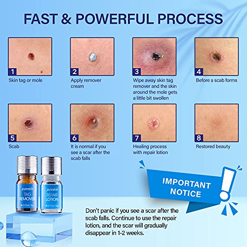 Pureskin Skin Tag Remover & Mole Corrector And Repair Lotion Set, Remove Tags...