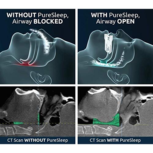 PureSleep Anti-Snoring Mouthpiece – Helps Stop Snoring – The Original Anti-Sn...