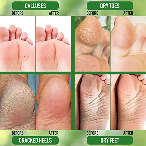 PurOrganica Urea 40 Percent Foot Cream - Callus Remover - Moisturizes & Rehyd...