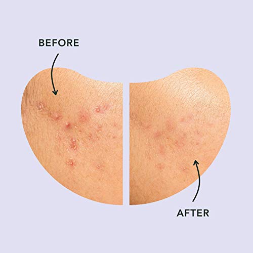 Rael Miracle Large Spot Control Cover - Long Size, Hydrocolloid Strip for Bre...