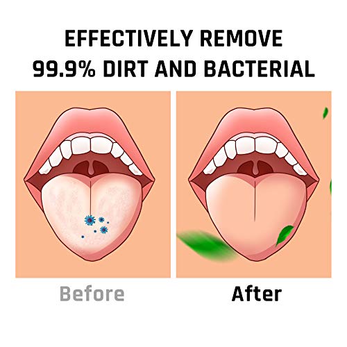Tongue Scraper, Tongue Cleaner Helps Fight Bad Breath,Professional Tongue Bru...