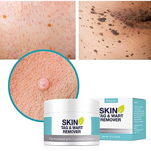 Skin Tag Remover, Warts & Mole Remover Cream, Skin Tags Dry and Fall Away, Sk...