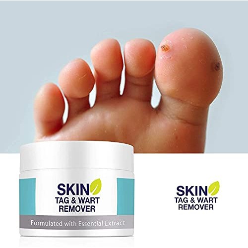 Skin Tag Remover, Warts & Mole Remover Cream, Skin Tags Dry and Fall Away, Sk...