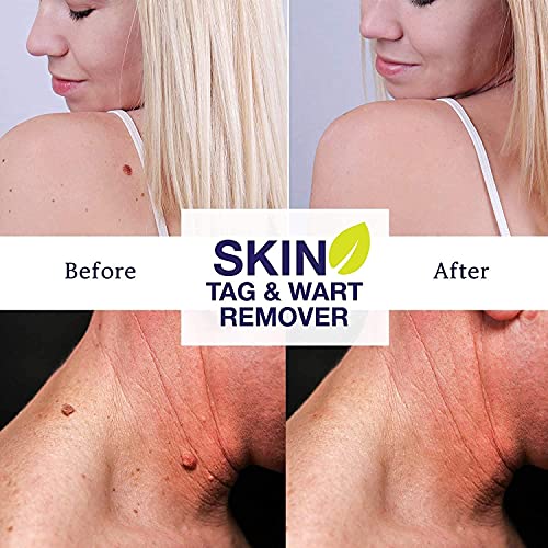 Skin Tag Remover, Warts & Mole Remover Cream, Skin Tags Dry and Fall Away, Sk...