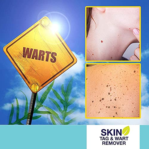 Skin Tag Remover, Warts & Mole Remover Cream, Skin Tags Dry and Fall Away, Sk...