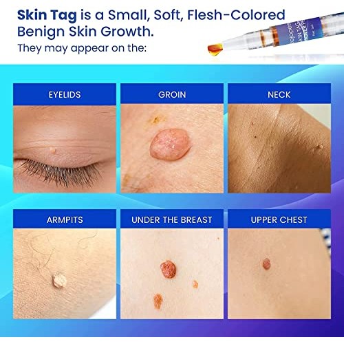 Skin Tag Remover, Warts & Mole Remover Pen, Skin Tags Dry and Fall Away, Skin...