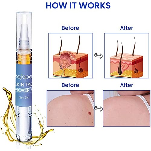 Skin Tag Remover, Warts & Mole Remover Pen, Skin Tags Dry and Fall Away, Skin...
