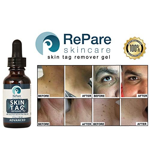 Skin Tag Remover Gel (1oz) - 40% Salicylic Acid, Tea Tree Oil
