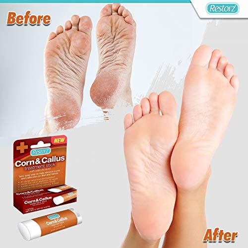 Restorz Corn and Callus Remover with Salicylic Acid, Fast Acting Treatment fo...
