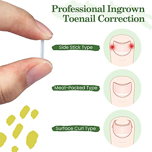 RMISODO 60 Pieces Ingrown Toenail Corrector Strips, Professional Toenail Corr...