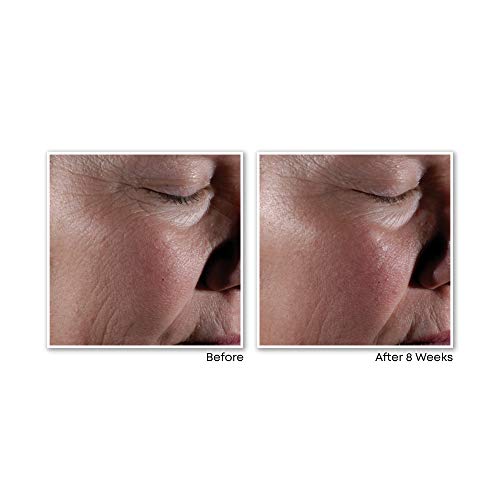 RoC Retinol Correxion Max Wrinkle Anti-Aging Skin Care System, Hyaluronic Aci...