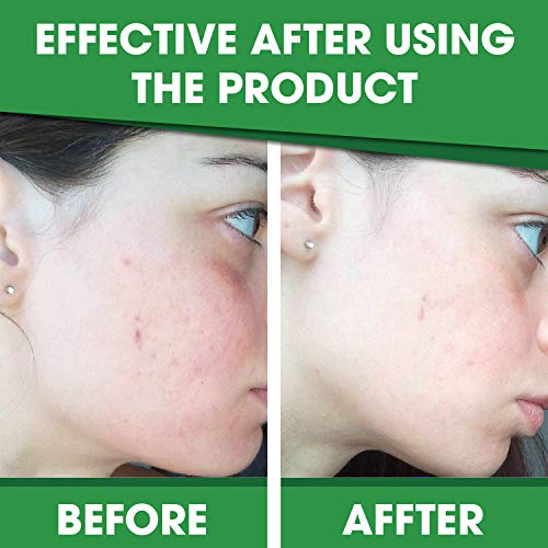 Rosponse TUHIMO Skin Tag Remover Patches, Safe Fast-Acting Skin Removal for W...