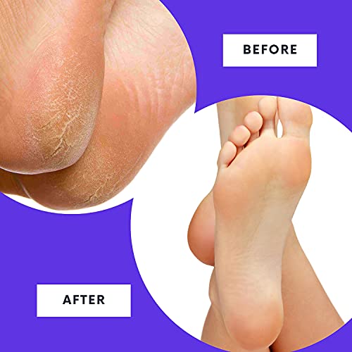 RoutineB Callus Remover For Feet - Extra Strength Callus Remover Gel Works We...