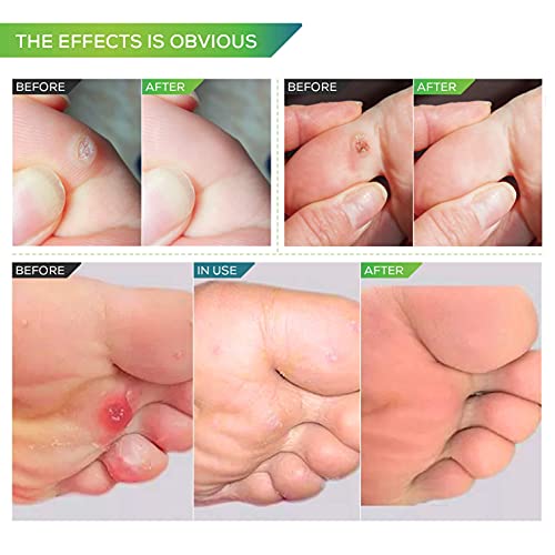 Samsali Corn Remover, 42 Corn Remover Pads, Toe Corn and Callus Removal, Corn...