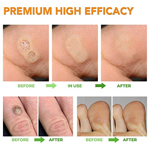 Samsali Wart Remover Pads, Highly Potent Wart Removal Treatment, All New Prem...