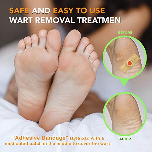 Samsali Wart Remover Pads, Highly Potent Wart Removal Treatment, All New Prem...