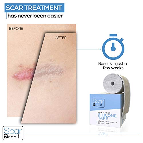 Silicone Scar Sheets - Keloid Scar Removal Treatment. Medical Grade Scar Patc...