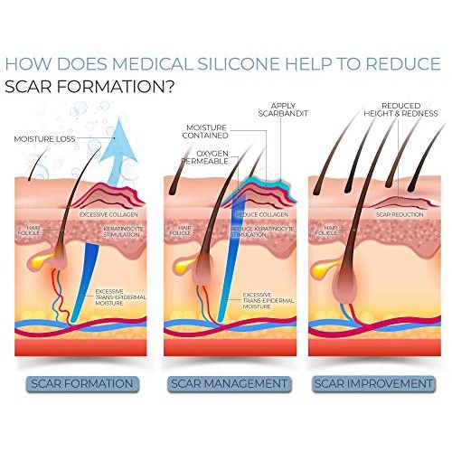 Silicone Scar Sheets - Keloid Scar Removal Treatment. Medical Grade Scar Patc...