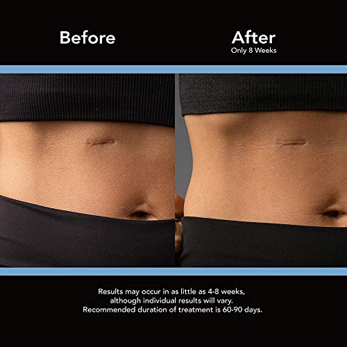 ScarAway Scar Diminishing Gel, 10 Gram