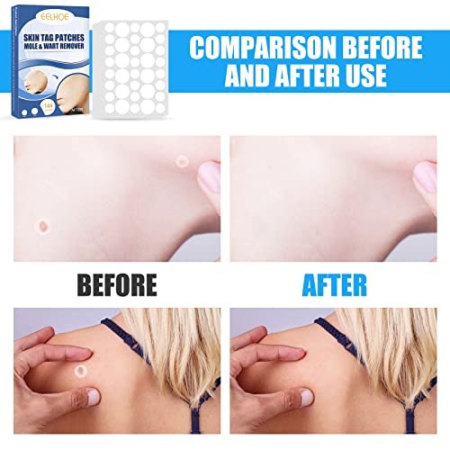144 Pcs Skin Tag Remover Patches, Wart Remover, Natural Ingredients for Safe ...