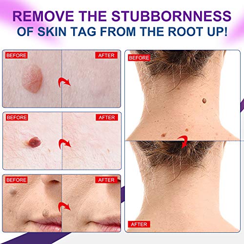 Skin Tag Remover,Extra Strength Skin tag Removal Serum,Made of Natural Plant ...