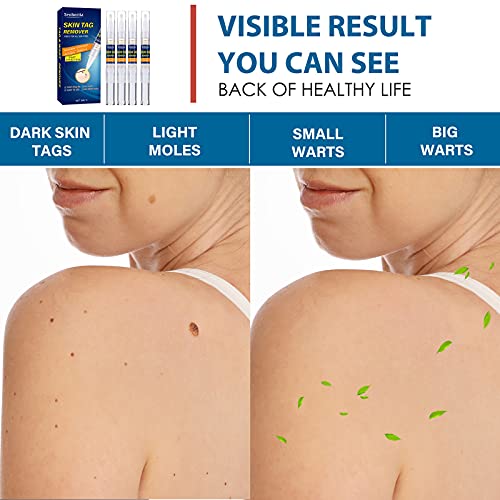 Skin Tag Remover, Extra Strength Skin tag Removal, Wart Remover, Tag Dry and ...