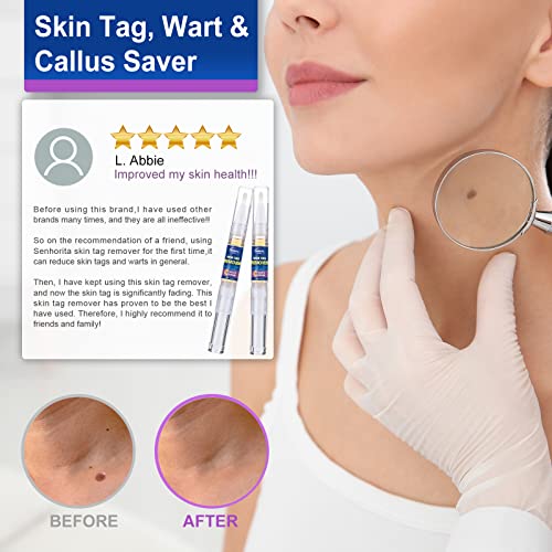 Skin Tag Remover, Wart Remover, Extra Strength Skin tag Removal, Tag Dry and ...