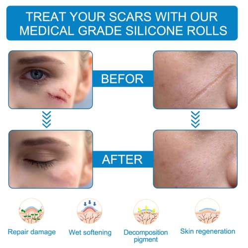 Silicone Scar Sheets(1.6'' x 60''), Medical Grade Scar Tape, Reusable Silicon...