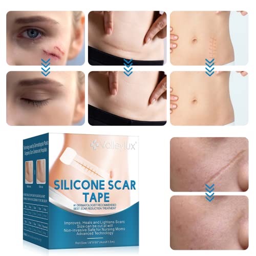 Silicone Scar Tape, Strips, Sheets (1.6” x 60”), Silicone Scar Tape Roll - So...