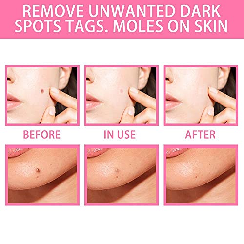 Organic Skin Tag Solution Serum Remover, Mole and Skin Tag Remover Dark Spot ...