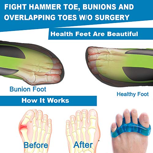 Premium Gel Toe Separators, Spacers & Straighteners, Bunion Correctors for Re...