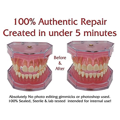 SmileFix Color Matching Deluxe Dental Repair Kit - Missing or broken tooth. G...