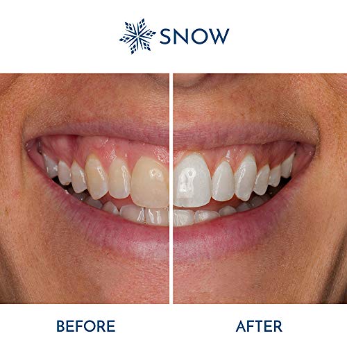 SNOW Teeth Whitening Kit with LED Light | Complete at Home Whitening System -...