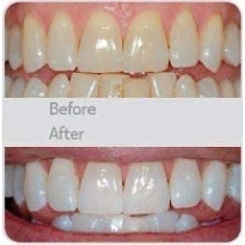 V-White Electric Toothbrush Adults - Ultrasonic U-Shaped Toothbrushes for Tee...