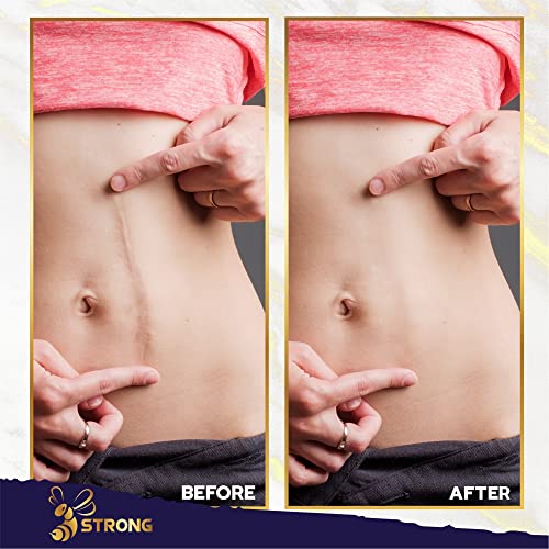 Potent Scar Removal Cream for Acne Scars, Surgery, Cuts, Burns - Stretch Mark...