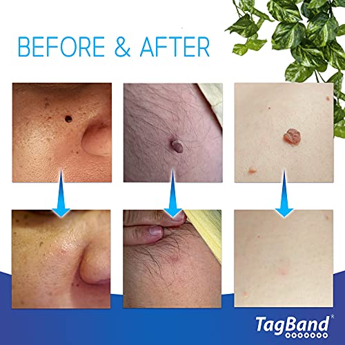 TagBand- Skin Tag Remover Device for Large Skin Tags (Includes 10x Removal Ba...