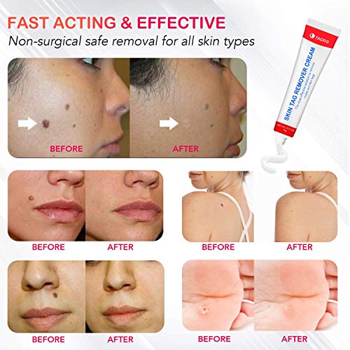 Skin Tag Remover, Warts Remover Cream,Quickly and Easily Remove Common Skin T...