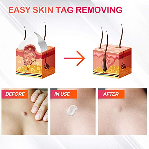 Skin Tag Remover, Warts Remover Cream,Quickly and Easily Remove Common Skin T...