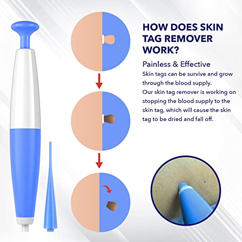 TAGRID Skin Tag Remover, Skin Tag Remover Device for Small to Medium (2mm -5m...